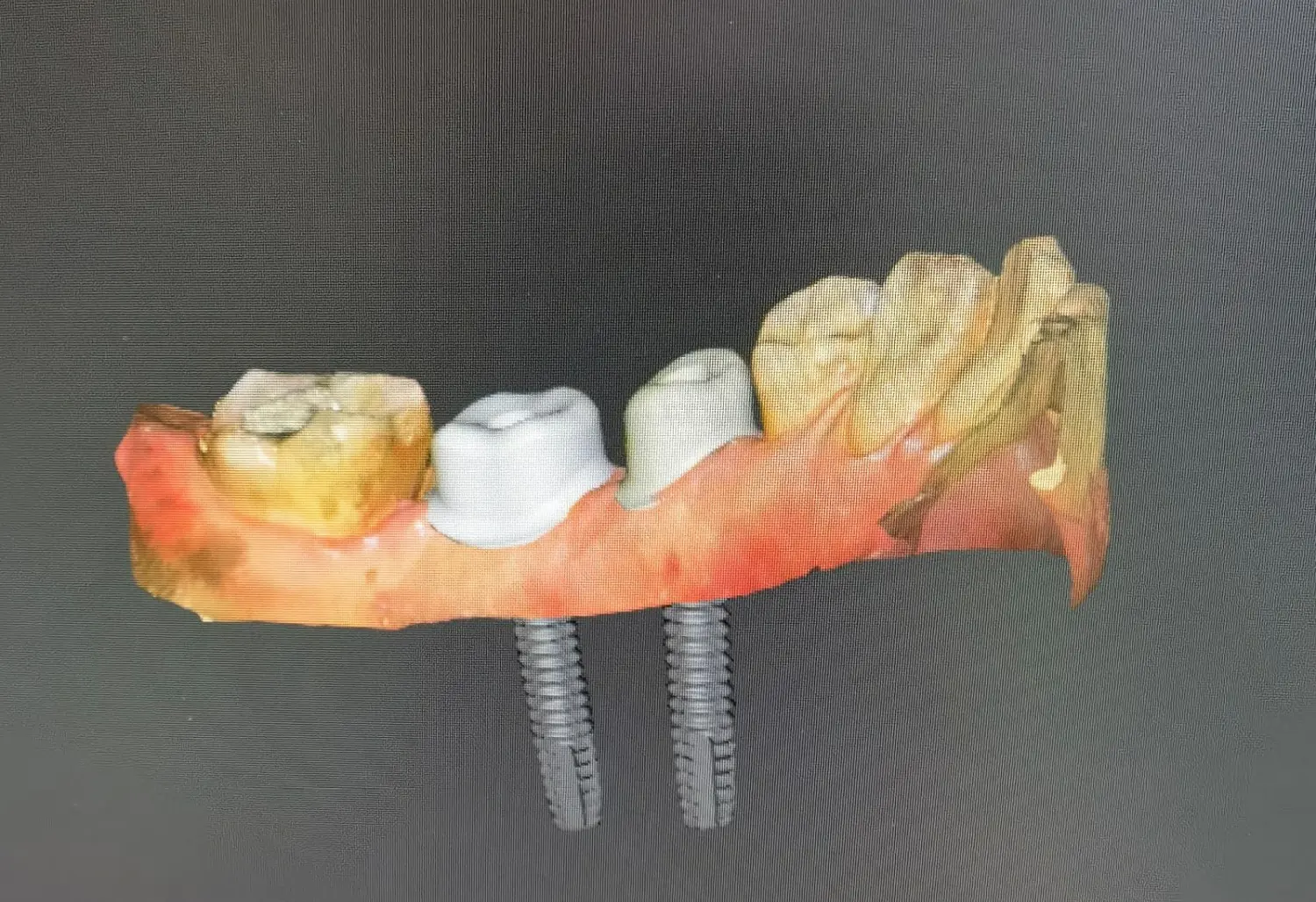 Implantatversorgungen